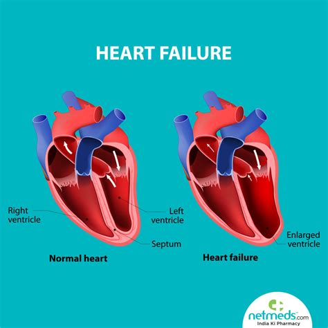 lv function medical abbreviation|what is severe Lv dysfunction.